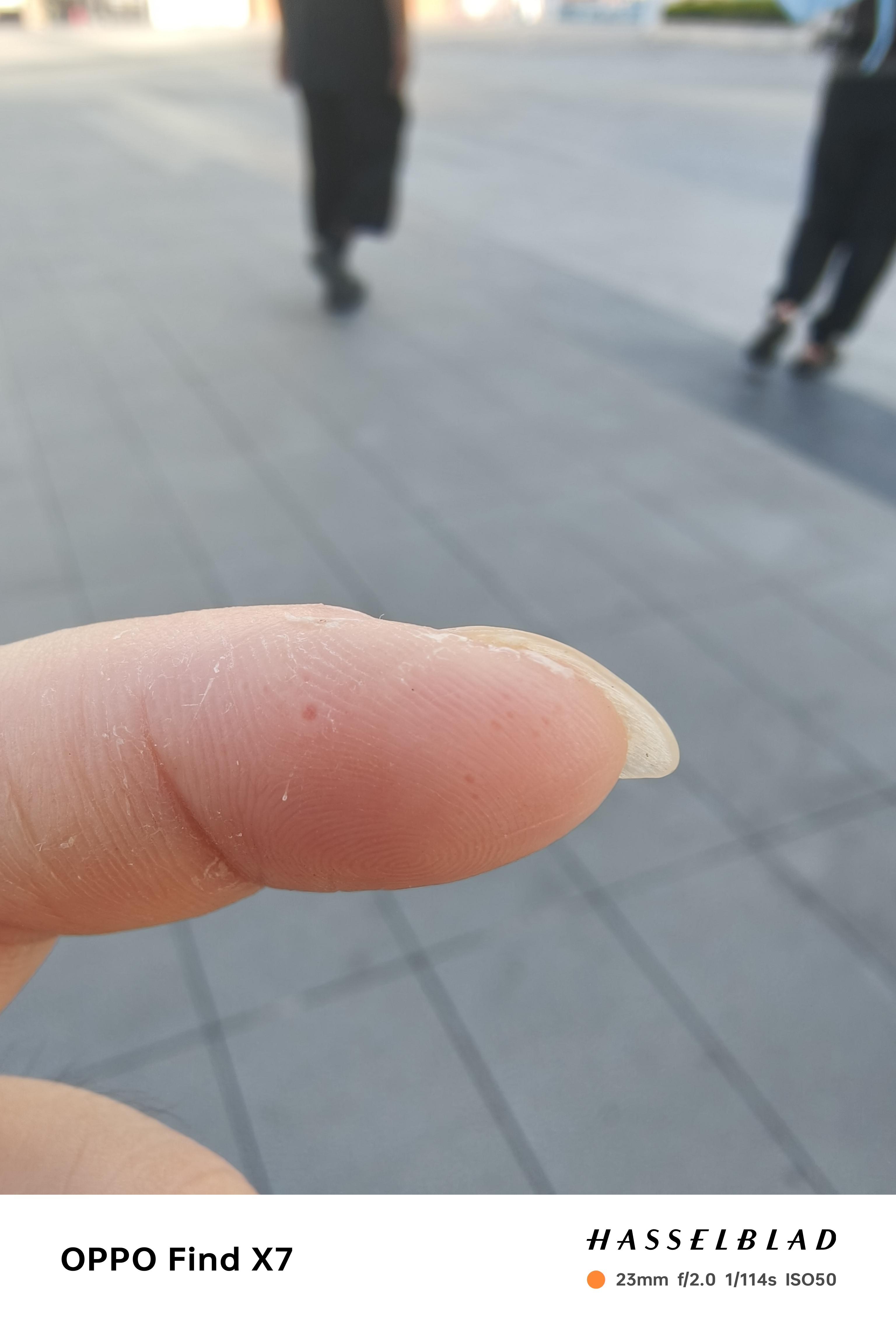 下辈子还能遇见 的想法: 手指头老是长这种针眼,慢慢发痒,有大神知道