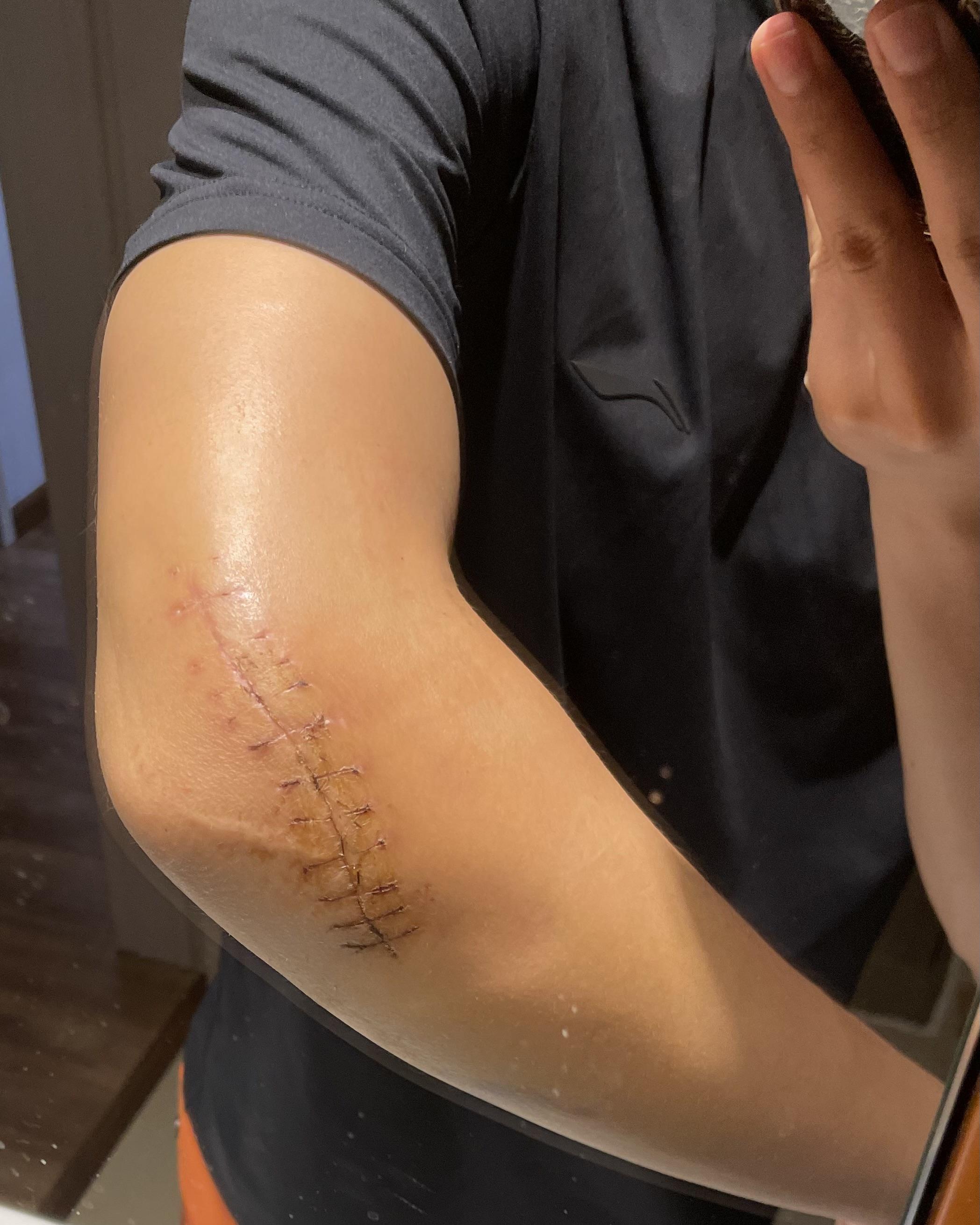 simba南 的想法: 手肘康复