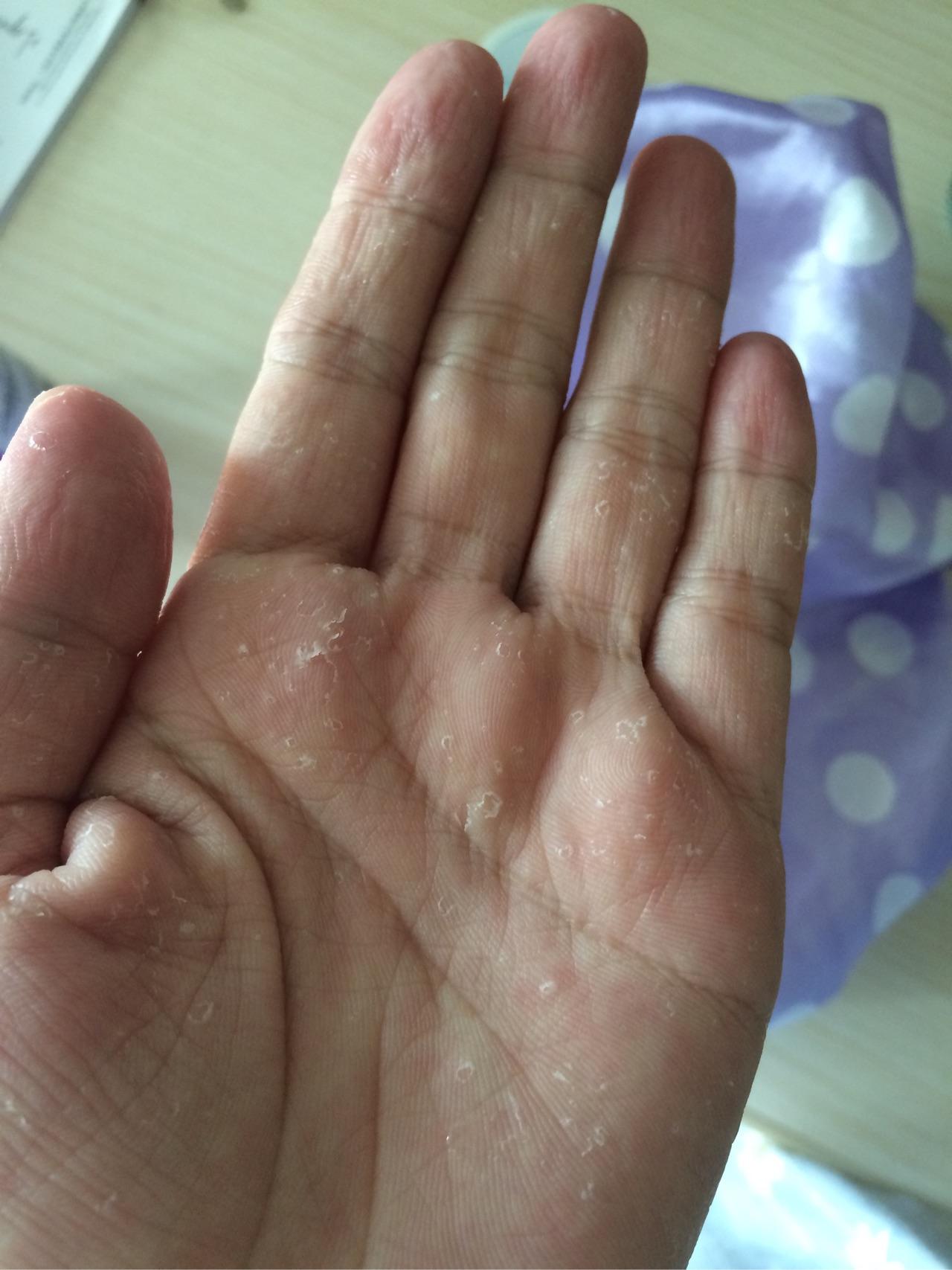 季节性手脱皮什么原因有什么方法可以根治吗