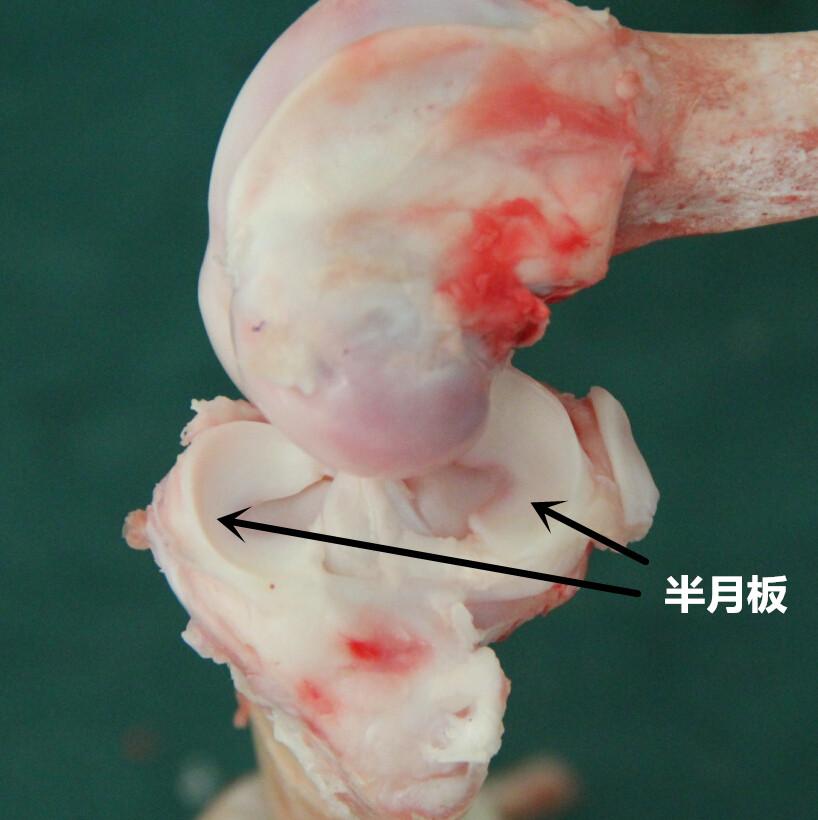 mri显示半月板撕裂,但抽屉实验没有症状是否手术? - 知乎