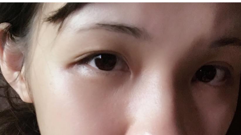 上眼皮较厚的内双贴双眼皮贴贴久了能永久双吗