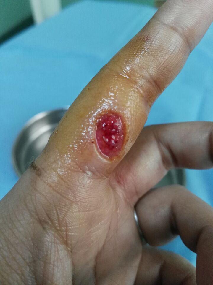 切菜被刀割了一个小口子去医院包扎下要190这收费合理吗