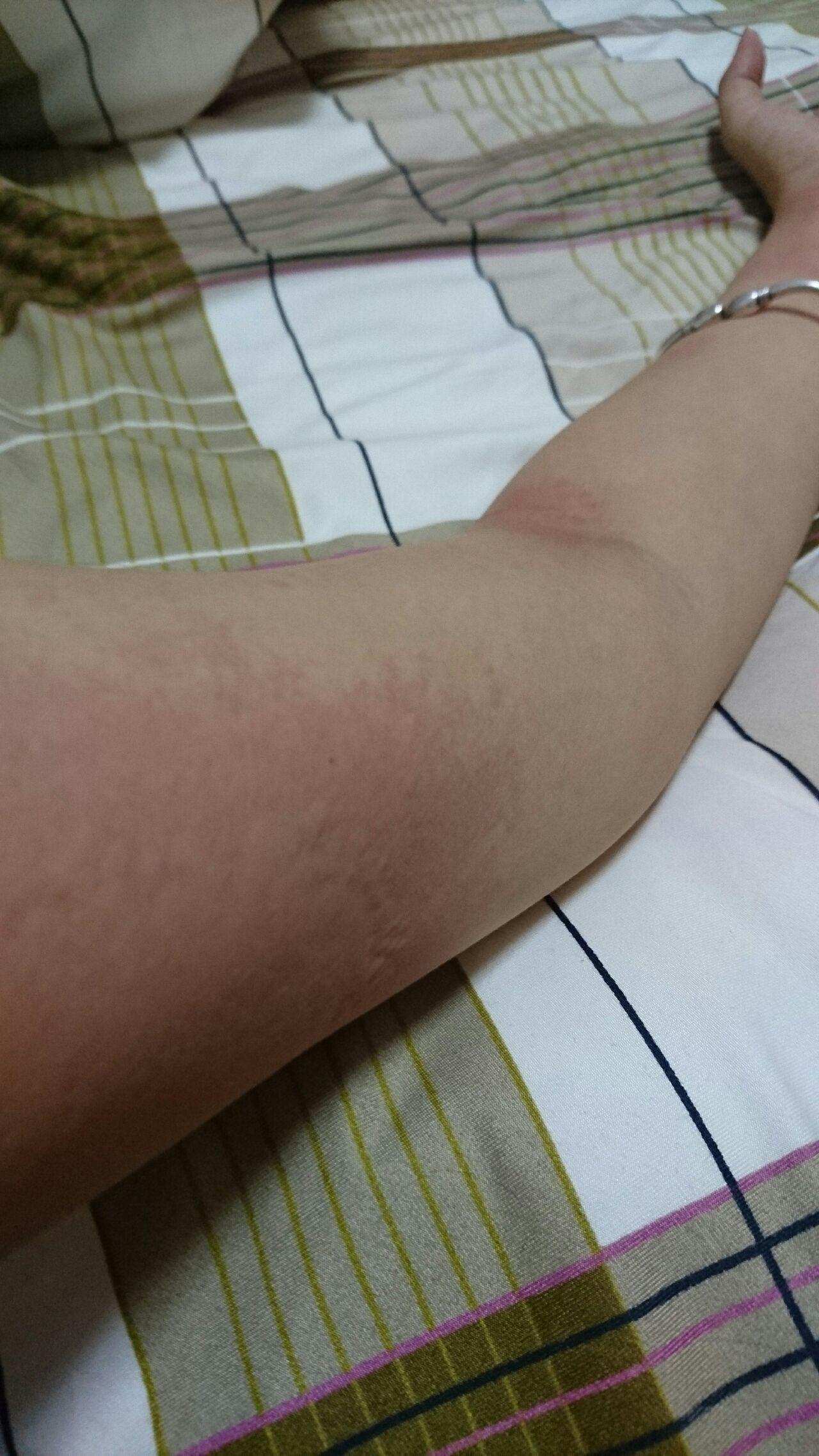 人工荨麻疹皮肤划痕症的原理是什么有治疗的必要么对人的影响大吗