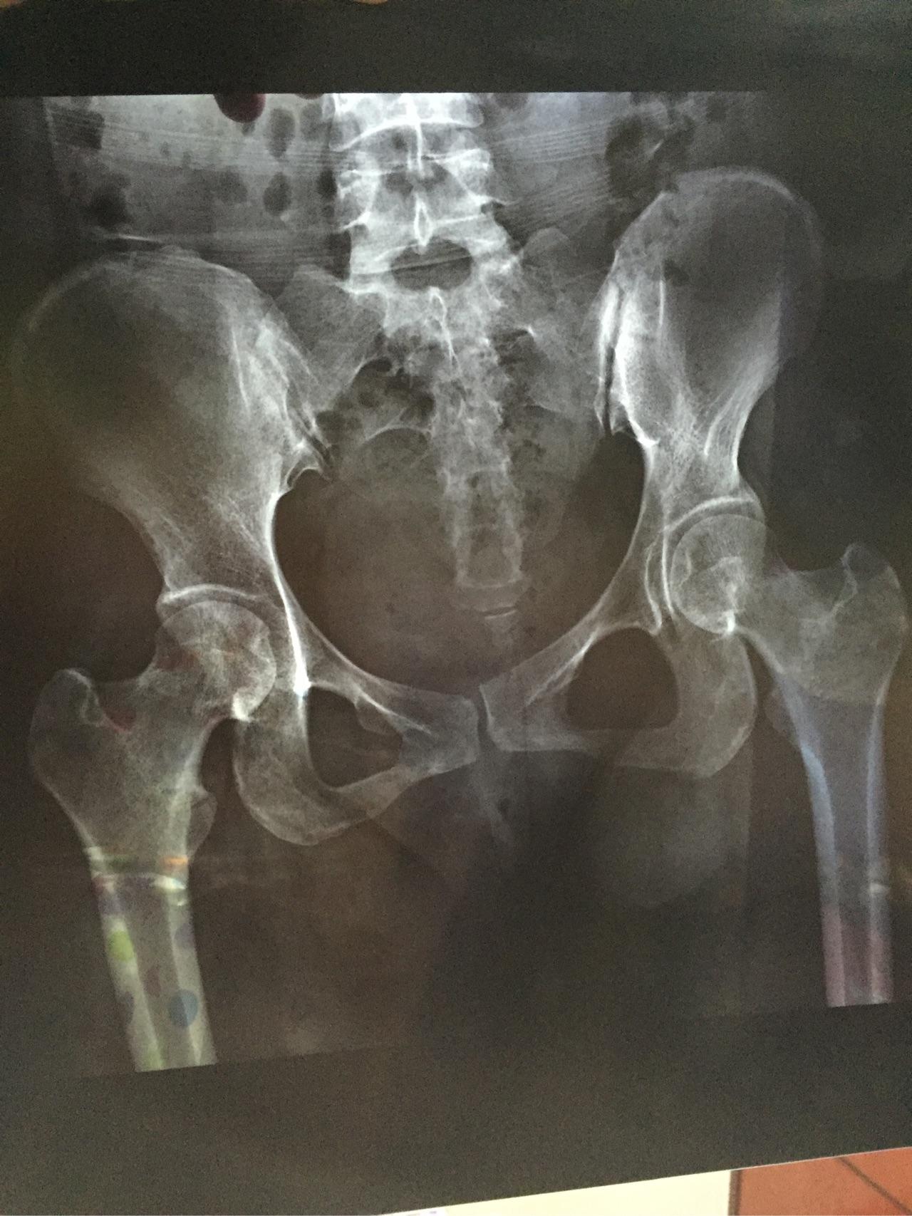 产后双侧致密性髂骨炎的症状