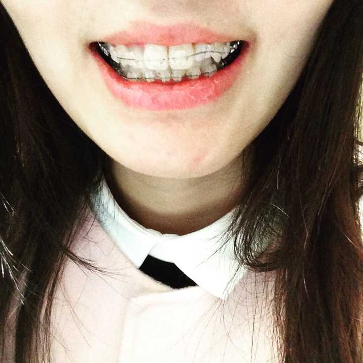 戴牙套的过程是怎样的？有什么危害？