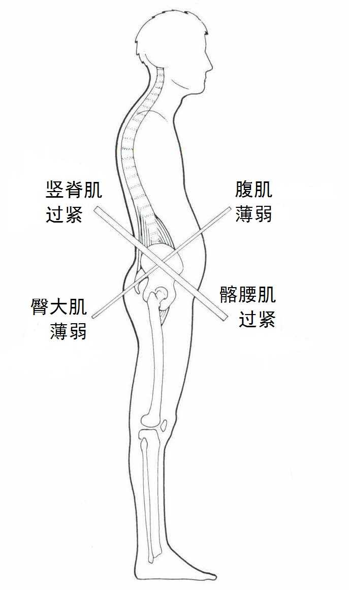 如何锻炼改善骨盆前倾 知乎