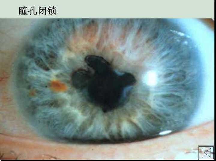 历史上的重瞳子是真实存在的吗？两个瞳仁在眼睛里是如何分布的？ - 知乎