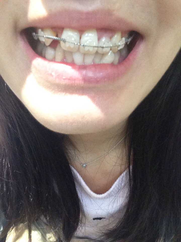 戴牙套的过程是怎样的?有什么危害?