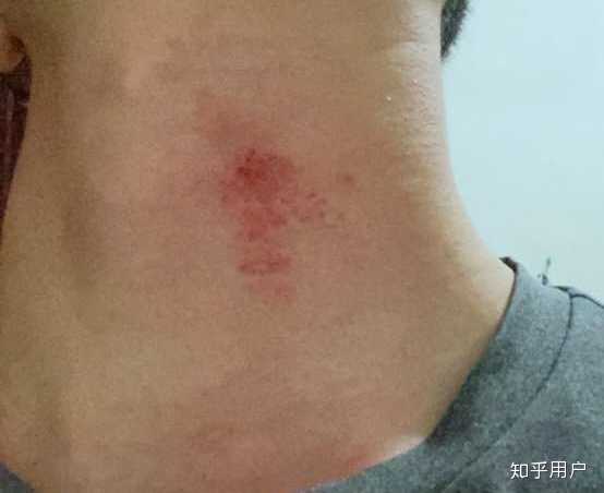 怎么在三小时内消除吻痕？ - 知乎