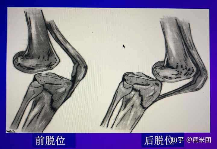 脱臼 关节脱位 是什么原因造成的 有何治疗手段与注意事项 它与 骨折 有什么区别 知乎