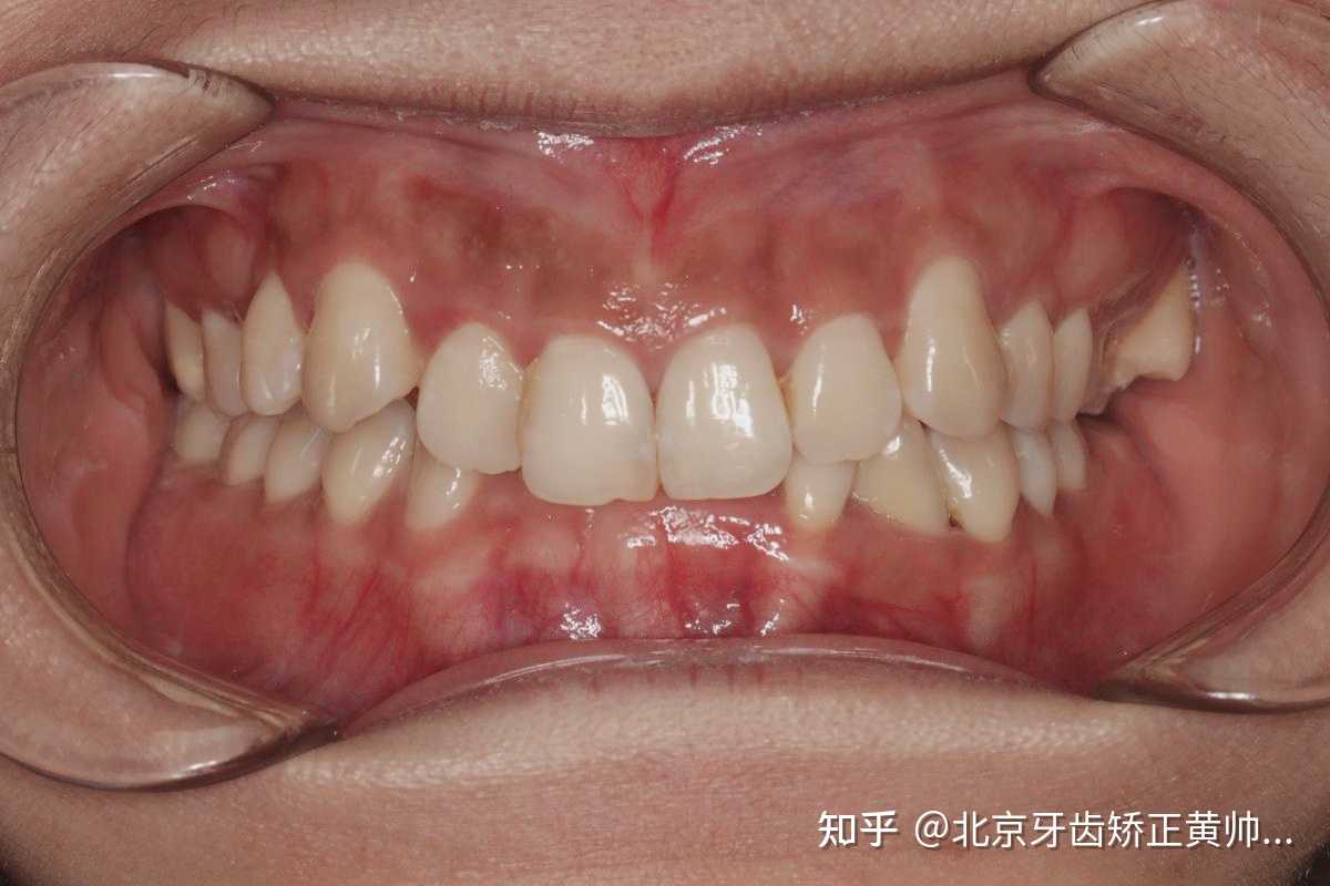 北京牙齿矫正黄帅医生 的想法: 内倾性深覆合会导致创伤性的咬合,由于