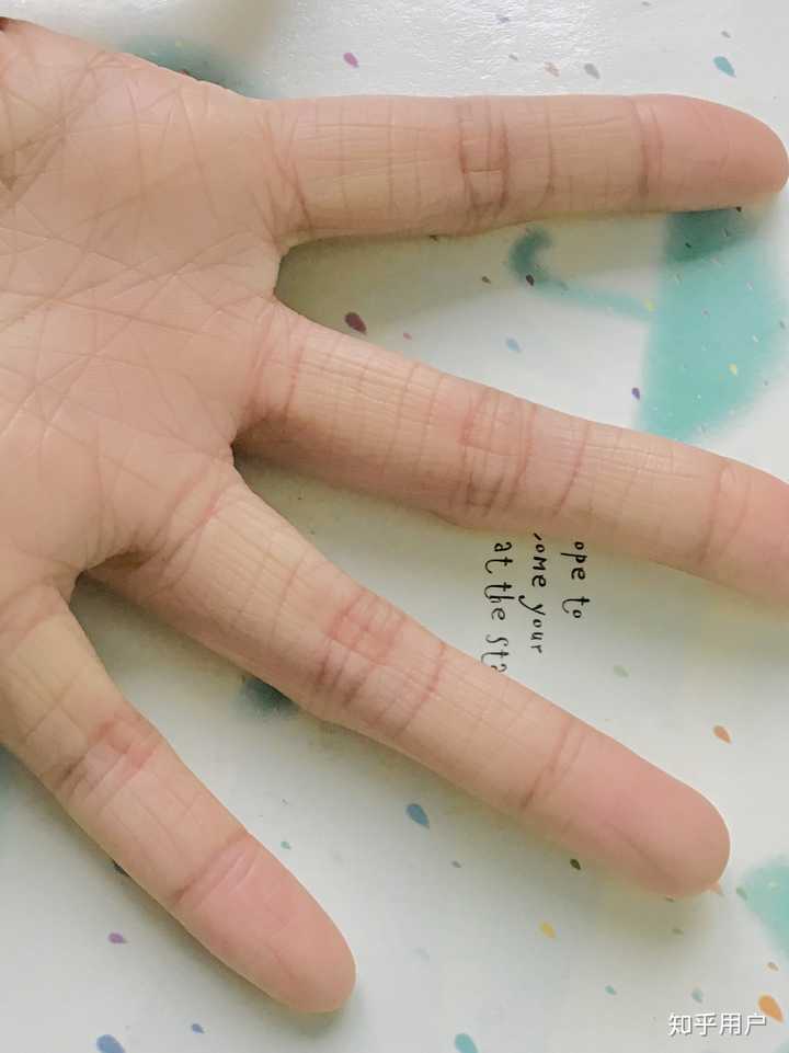 鱼鳞病还有未来吗 知乎 鱼鳞病还有未来吗 知乎
