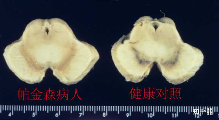 帕金森跟多巴胺有什么关系? - 知乎
