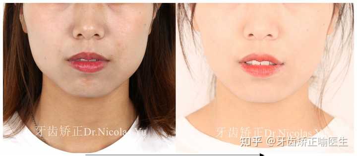 整牙成功是什么体验 知乎