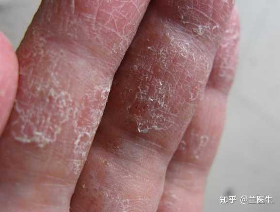 手上一直起皮瘙痒,试了很多药,反反复复,要怎么处理一下? - 知乎