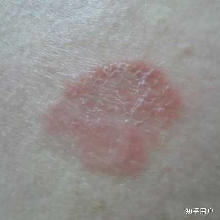 股癣的症状表现有什么？ 知乎 