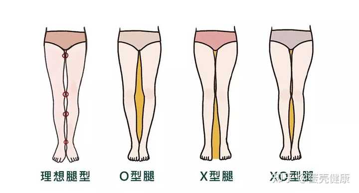 怎样纠正x型腿 知乎