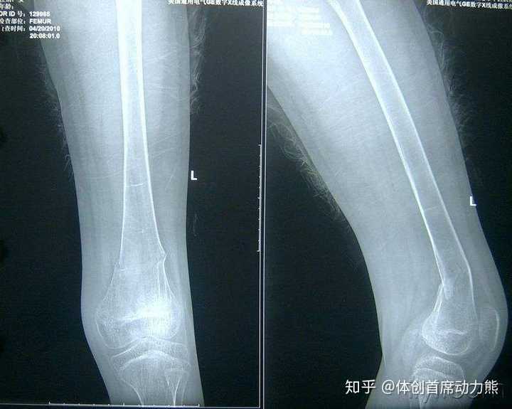 什么叫青枝骨折? - 知乎