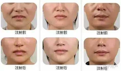 眼角纹、法令纹、鼻沟纹,这些皱纹产生的原因有哪些? - 知乎