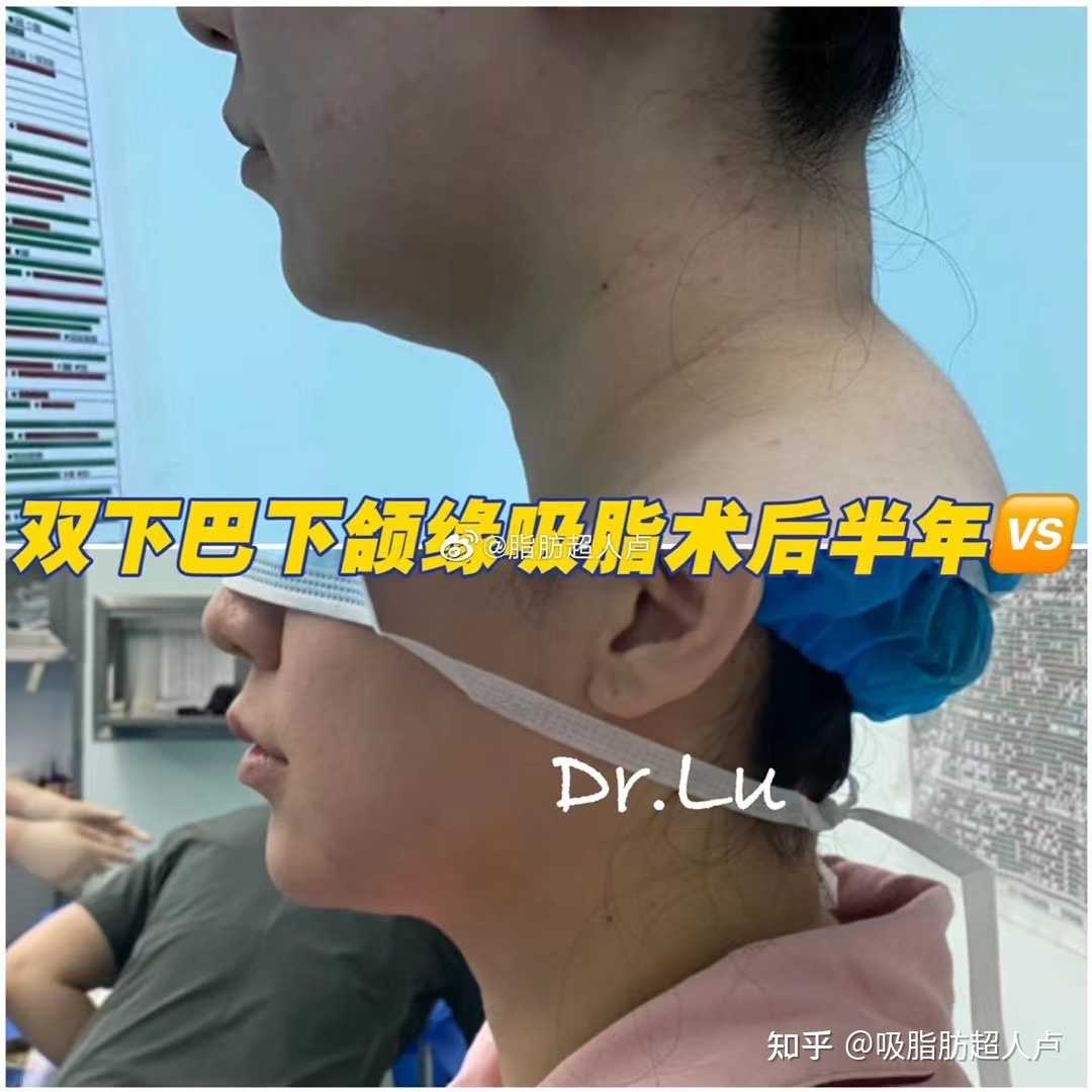 吸脂肪超人盧 的想法: 富貴包 雙下巴下頜緣吸脂