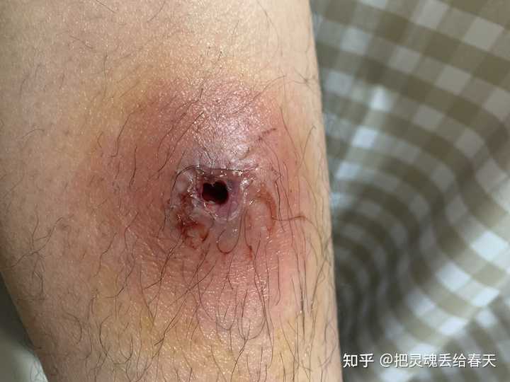 一个火疖子能大到什么地步 知乎