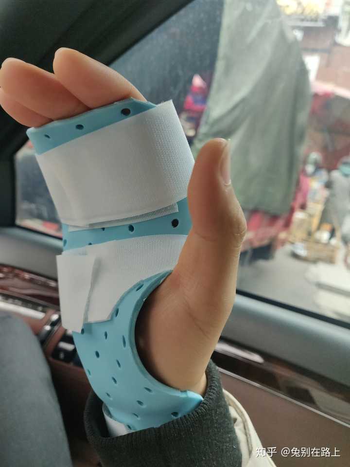 右手第五掌骨骨折 刚做完手术 正在恢复中 求前辈指教有什么好的健身方法 不伤手 还能锻炼 知乎 右手第五掌骨骨折 刚做完手术 正在恢复中 求前辈指教有什么好的健身方法 不伤手 还能锻炼 知乎