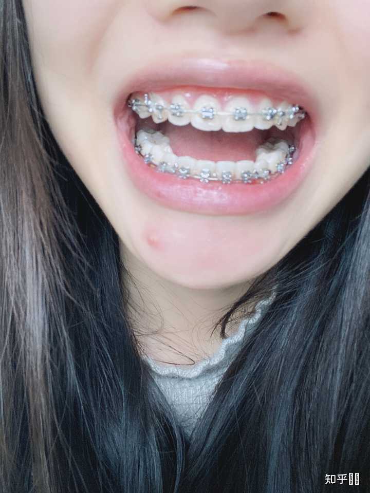 戴牙套花了你多少钱？