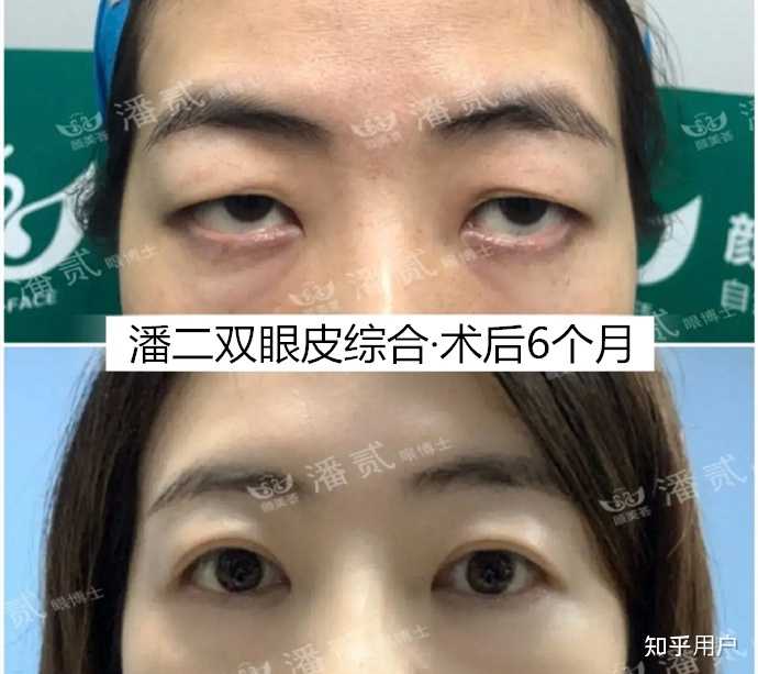 请问下三白眼如何改善呢? - 知乎
