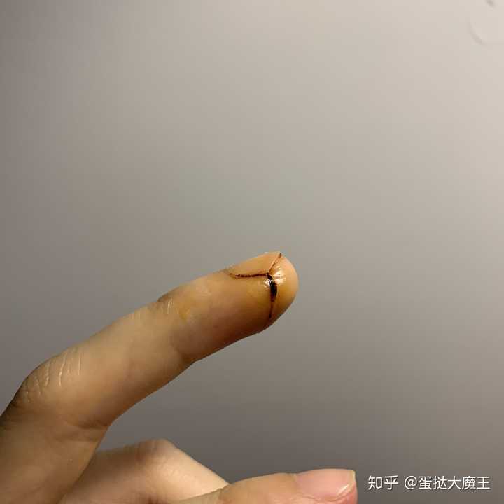 平时手指被割伤应该怎么处理? - 知乎