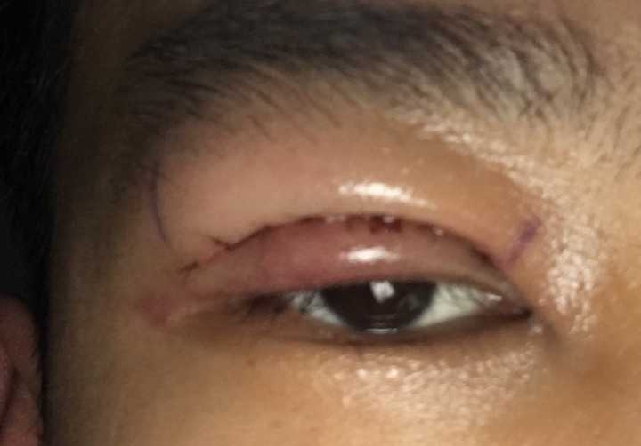 双眼皮的价格_郑大一附院割双眼皮价格_全切双眼皮价格