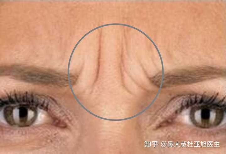 川字纹是怎么引起的？ - 知乎