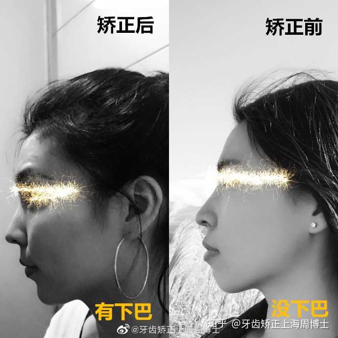 你会选择一个正在牙齿矫正的女生做女朋友吗 知乎
