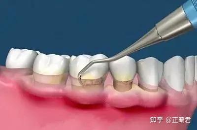 亿博电竞平台南京种植牙医院排名前十名“公开宣布”人工种植牙有哪些优势(图1)