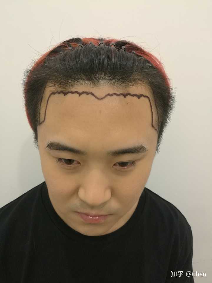 植发大概需要多少钱 知乎 植发大概需要多少钱 知乎