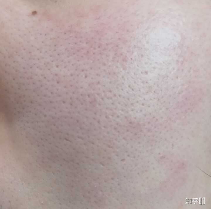 脸上红痘印变成黑色了？ - 知乎