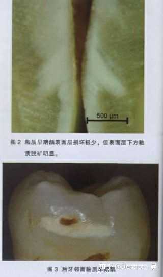 牙齿的矿化和脱矿是什么意思? - 知乎