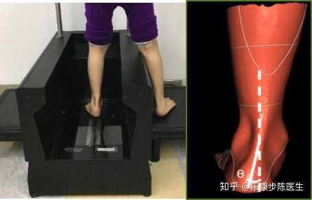 足外翻能矫正吗 知乎