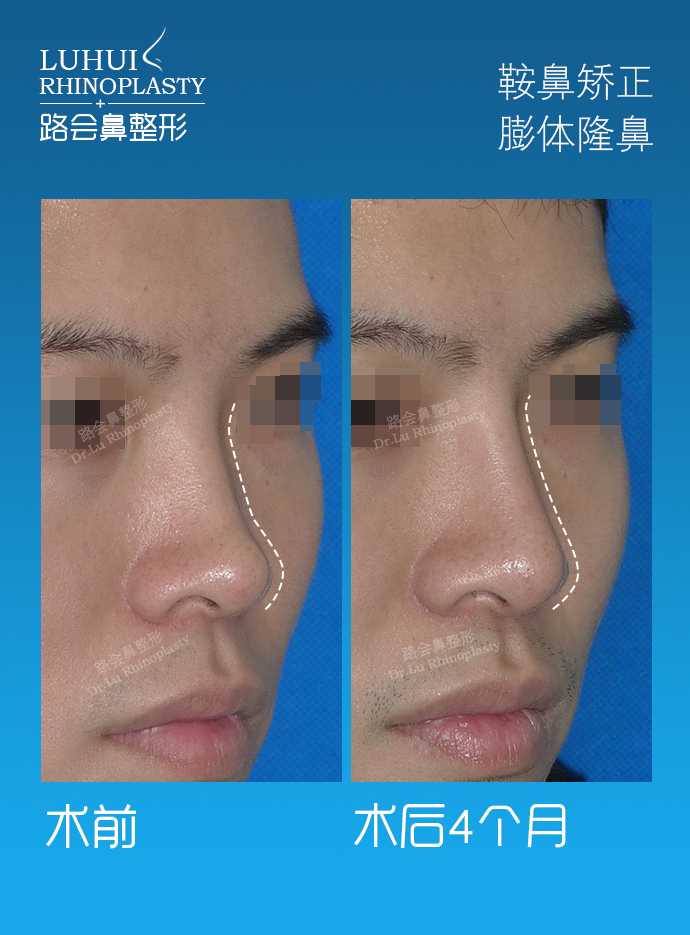 膨体隆鼻真的容易感染吗 知乎 膨体隆鼻真的容易感染吗 知乎