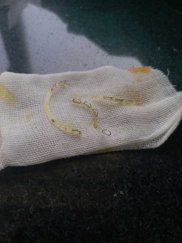 一次性包皮环切缝合器割包皮什么感觉？ - 知乎