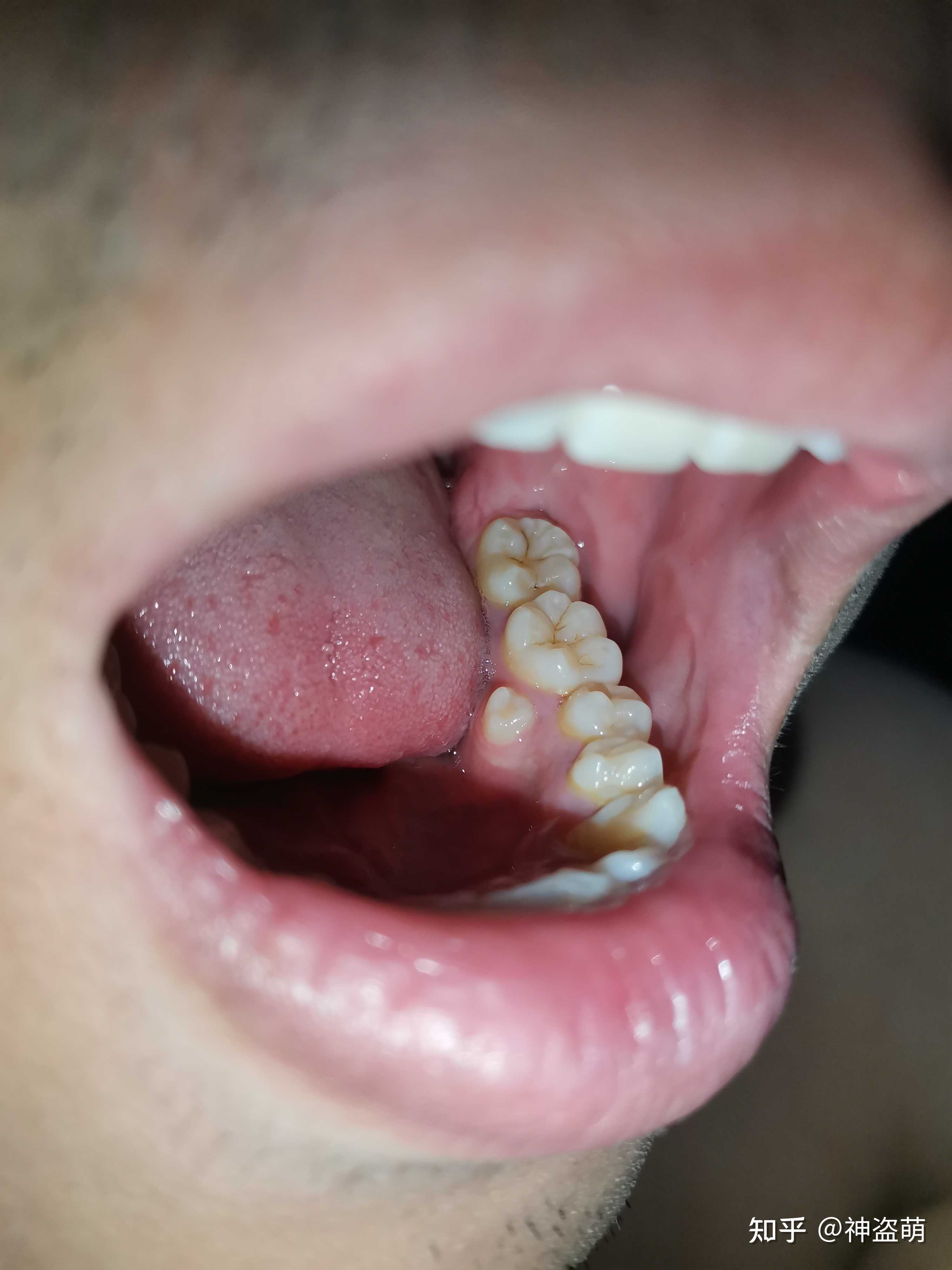 神盗萌 的想法: 有没有帅哥美女知道为啥我牙齿内壁多长了… - 知乎