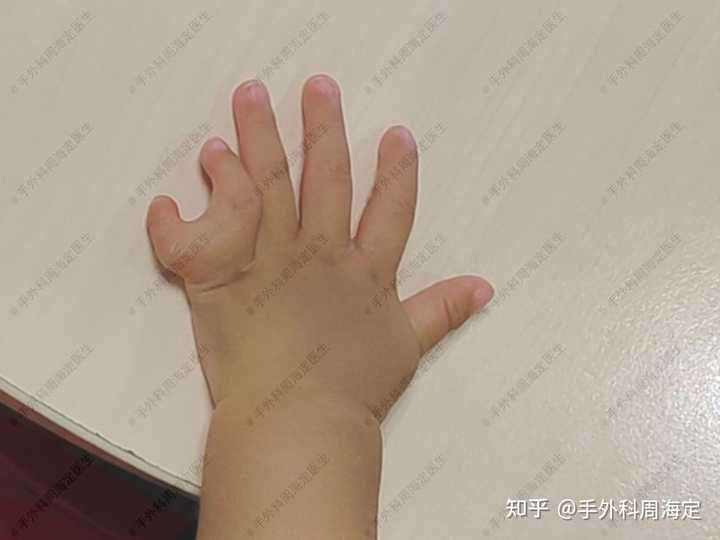 多指/并指是什么体验? - 知乎