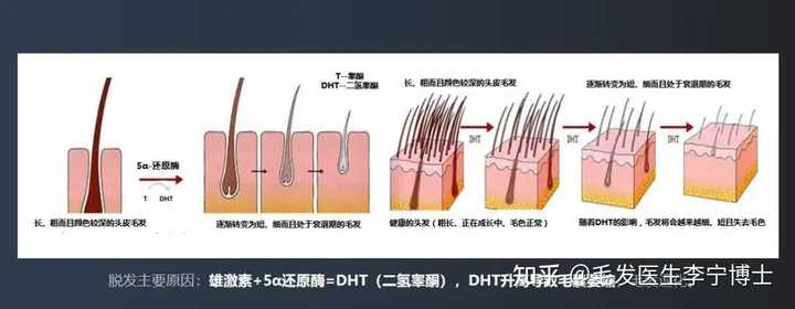 如何抑制或减少DHT生成? - 知乎