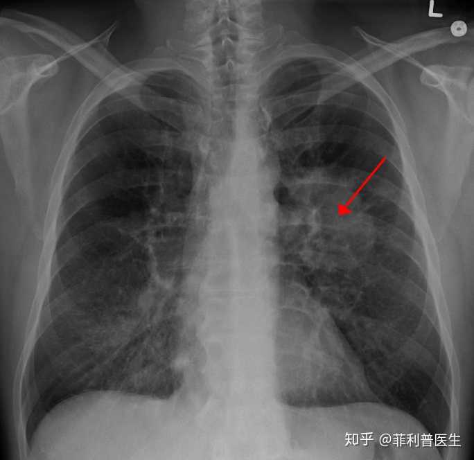 癌症是怎样被检查出来的 普通体检能查出癌症吗 知乎