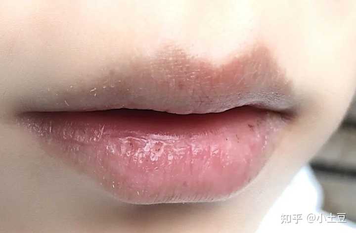 嘴周围有黑色素沉淀怎么办 知乎