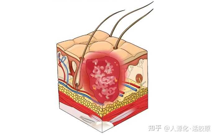 皮肤一直渗液怎么办? - 知乎
