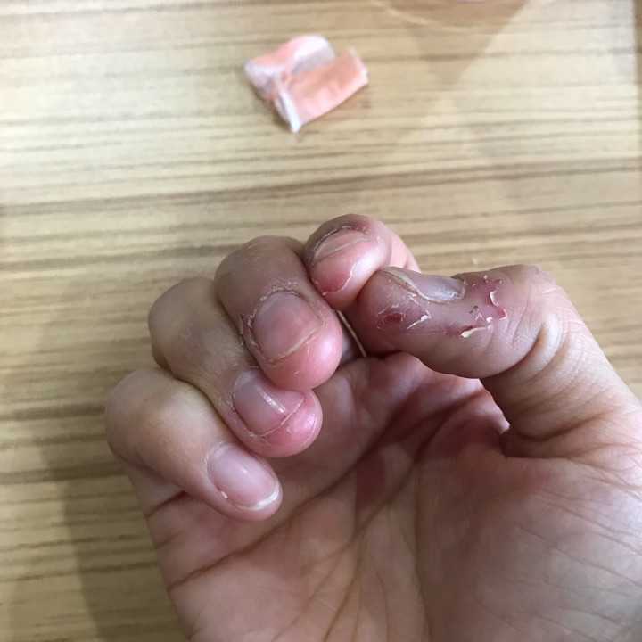 如何控制不自觉的没完没了的撕手皮 如何恢复手指皮肤的状态 比如已经撕的惨不忍睹了 知乎 如何控制不自觉的没完没了的撕手皮 如何恢复手指皮肤的状态 比如已经撕的惨不忍睹了 知乎