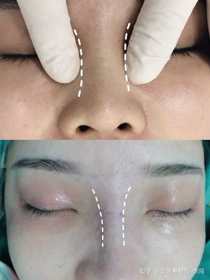 有鼻骨宽的做鼻骨内推手术的吗 知乎 有鼻骨宽的做鼻骨内推手术的吗 知乎