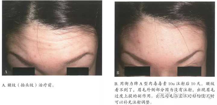面部皱纹的分类和形成原因是什么?如何科学除皱? - 知乎
