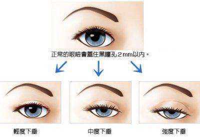 郑大一附院割双眼皮价格_全切双眼皮价格_双眼皮的价格