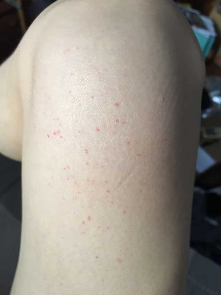 成人过敏性紫癜有痊愈的吗？ - 知乎